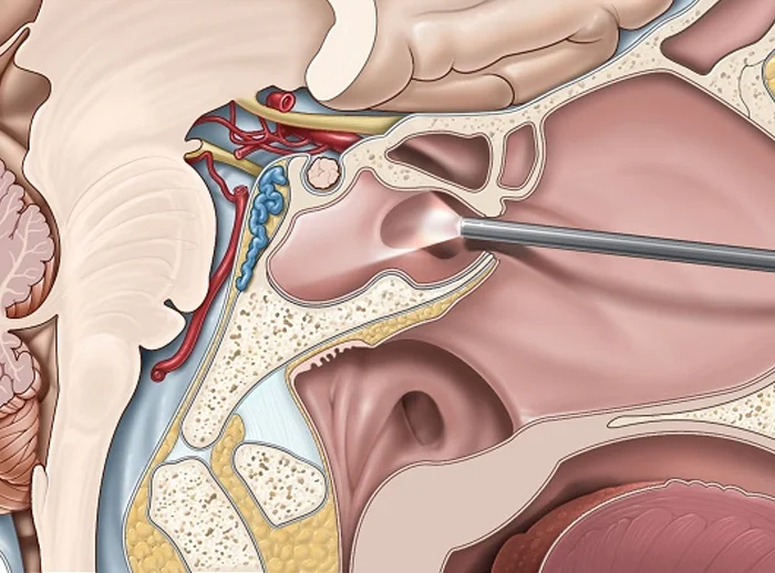 Skull Base & Cranial Base Surgery - IBS Hospital Delhi